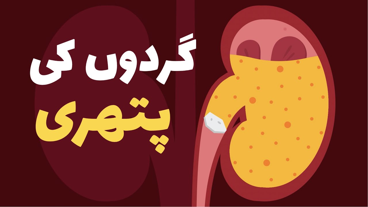 گردے کے پتھر
