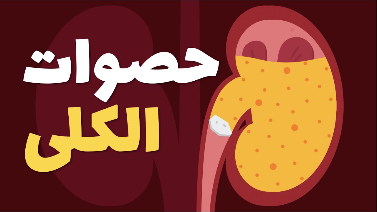 حصى الكلى