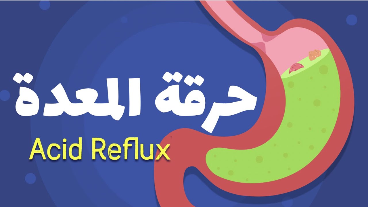 ارتجاع الحمض (GERD)
